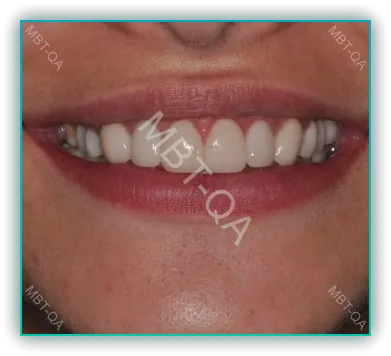 앞니 임플란트 형태1