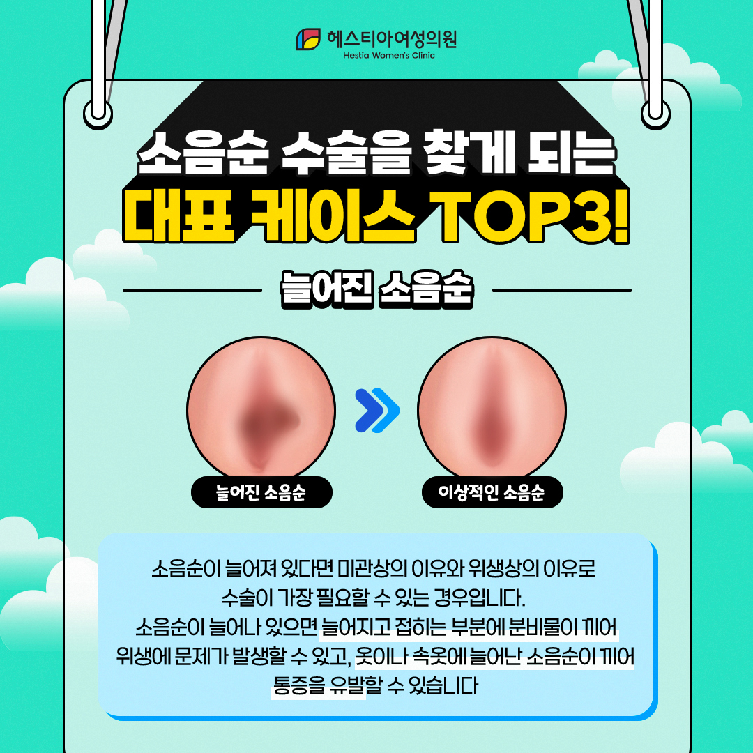 늘어진소음순