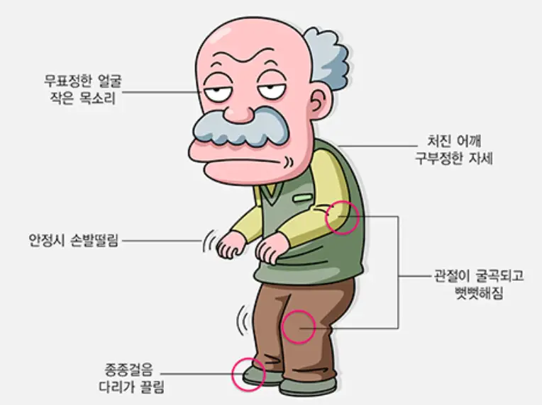 파킨슨병-주요증상-이미지