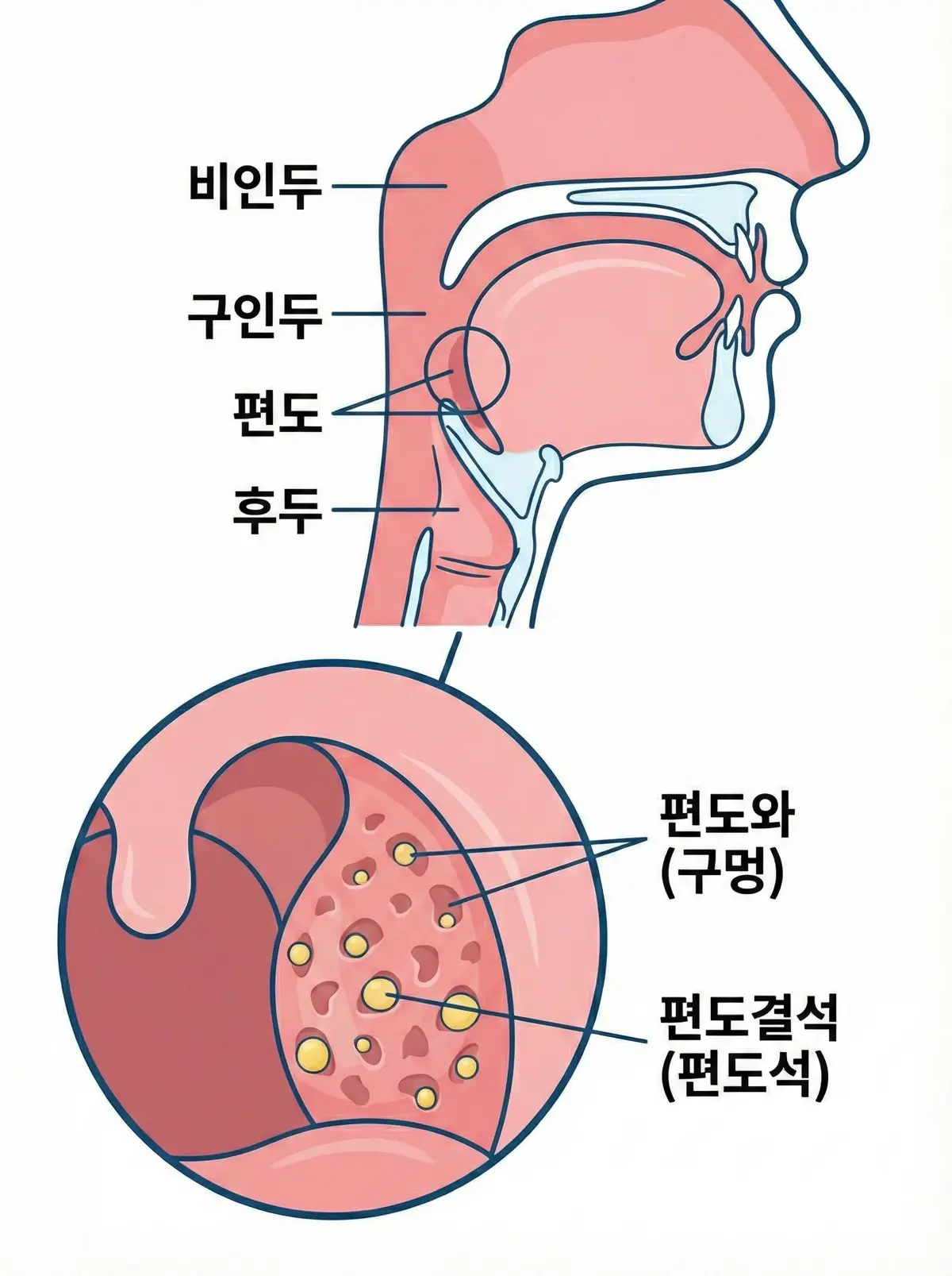 편도결석 인포그래픽