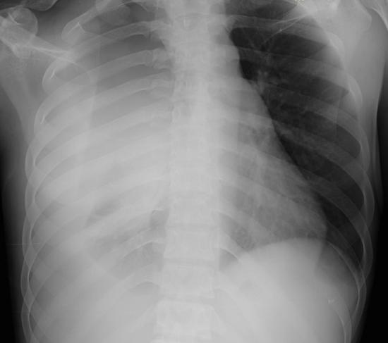 흉막박피술(Pleurectomy): 절차, 목적 및 회복 과정