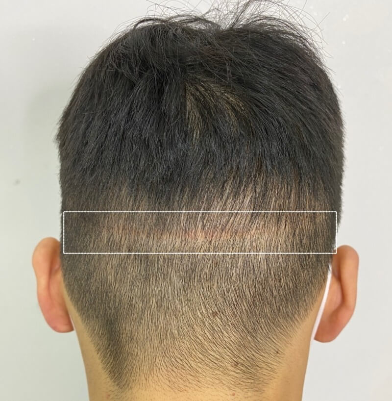 모발이식 3000모 비용