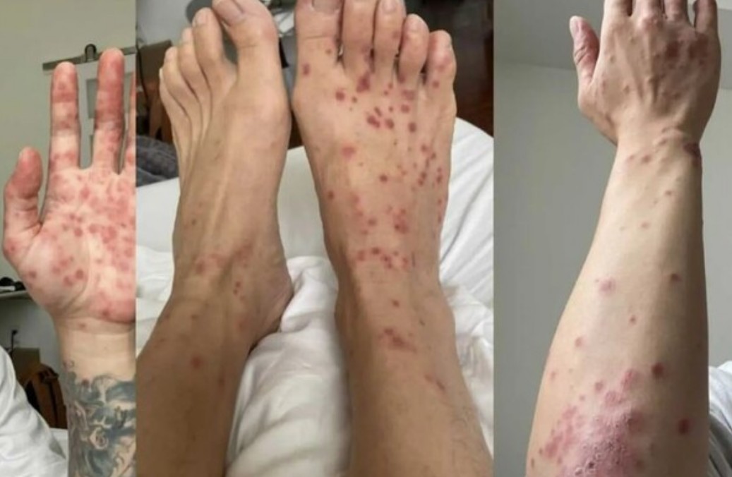 엠폭스 뜻 어떤 증상 및 원인 엠폭스 격리 및 예방접종 자세하게 알아보자