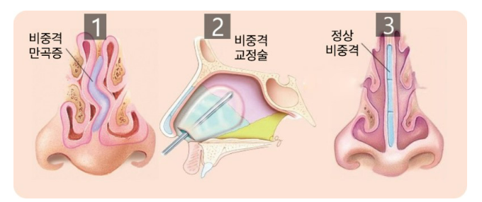 비중격-코성형술