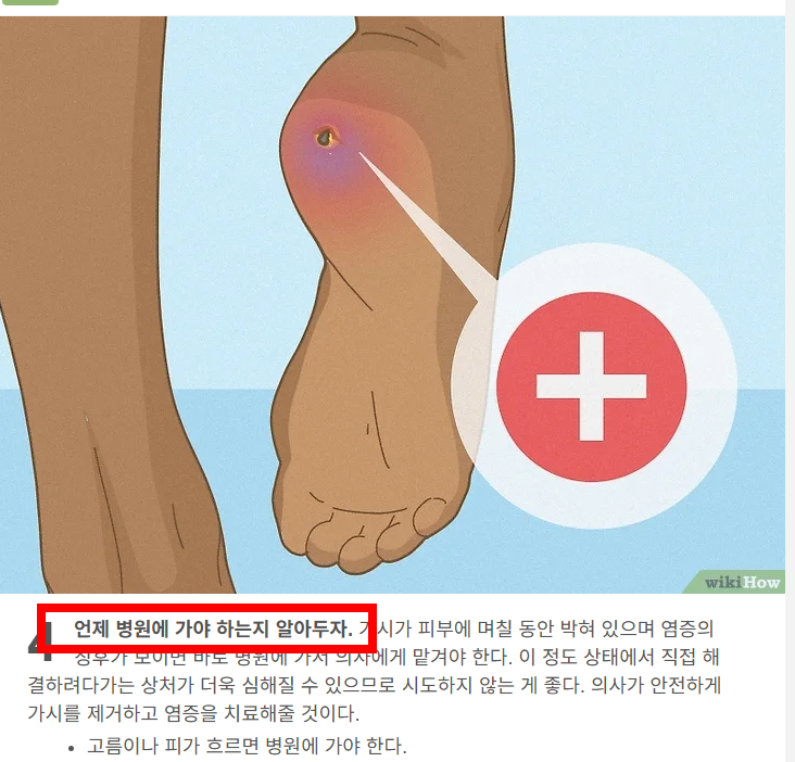 손가락 가시 빼는법 소개