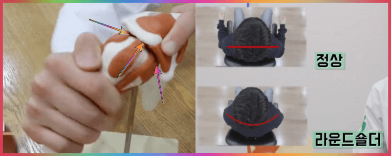 회전근개 파열 위치 및 라운드 숄더 모습