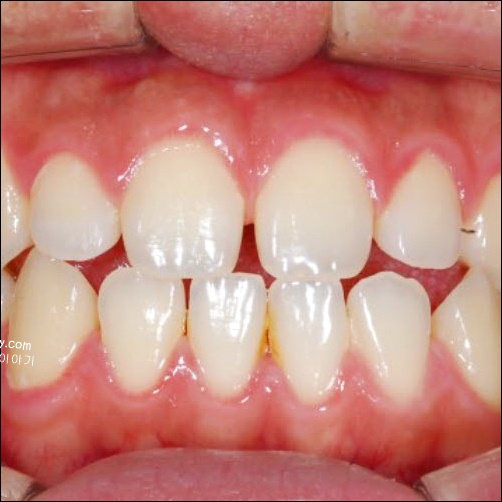 앞니 틈새 부분 교정