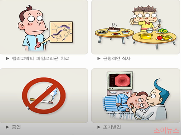 위암의 발생 원인