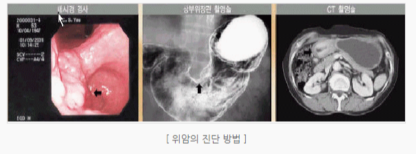 위암진단