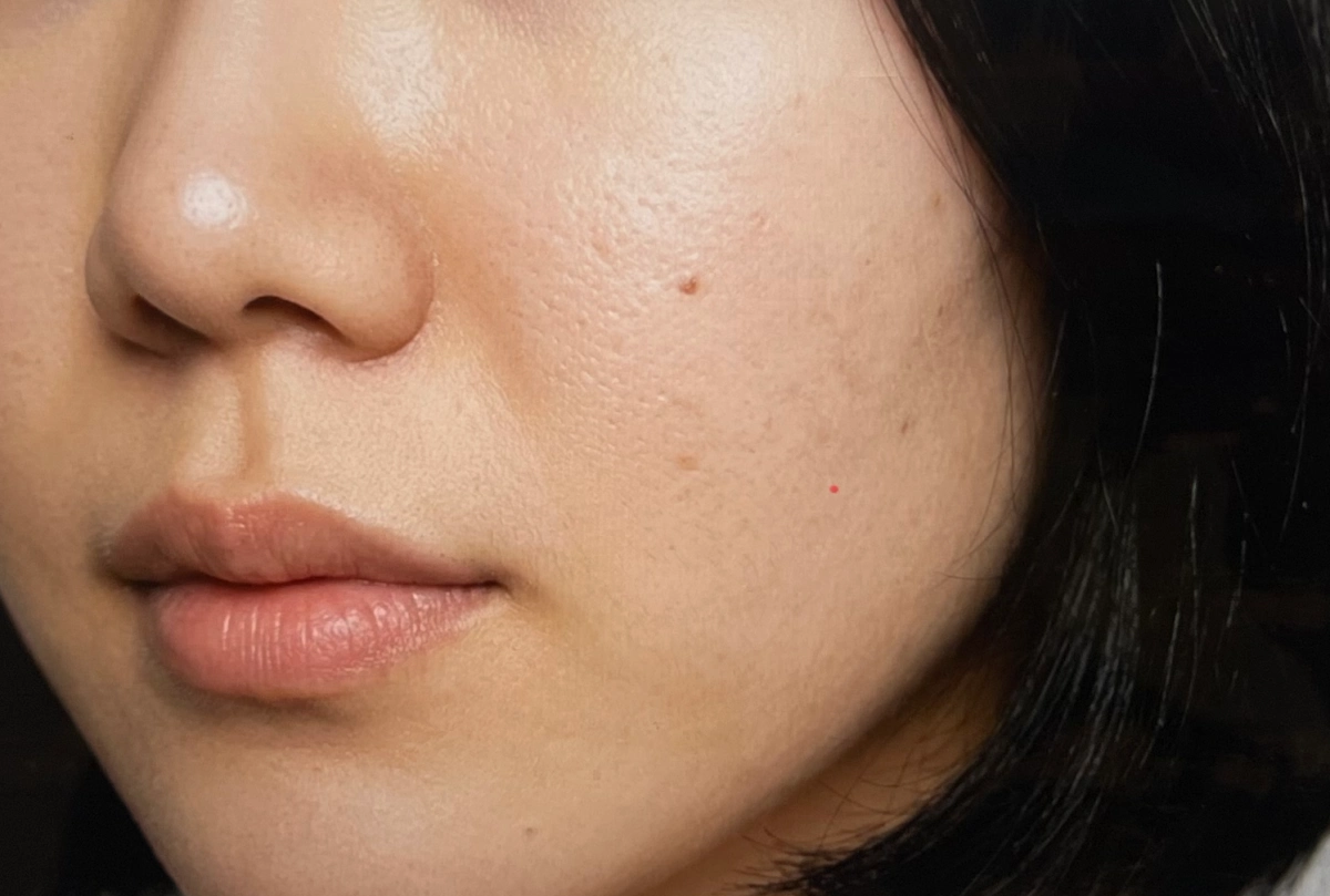 나린플라 3f 리프팅 앰플 후기 증명하기 위한 에프터 사진