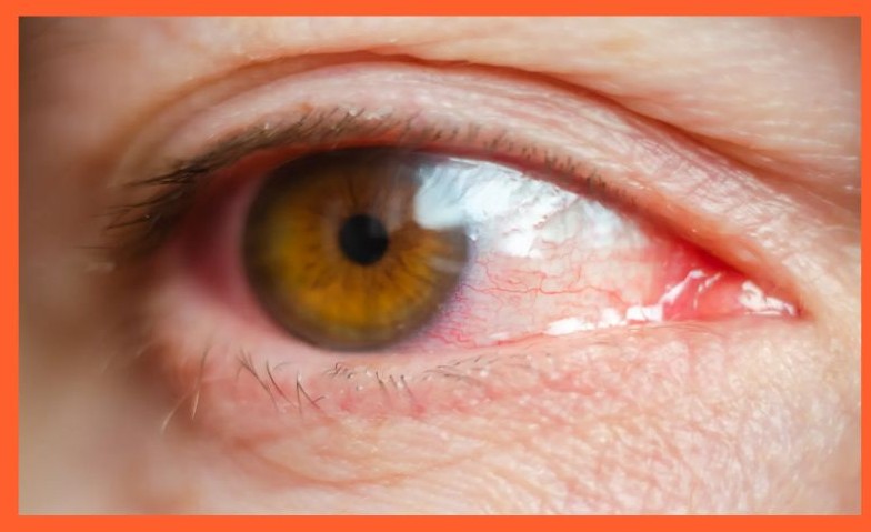 포도막염 증상 원인