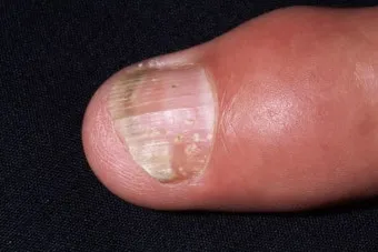 손톱이 갈라지는 이유 원인 증상 대처법_8