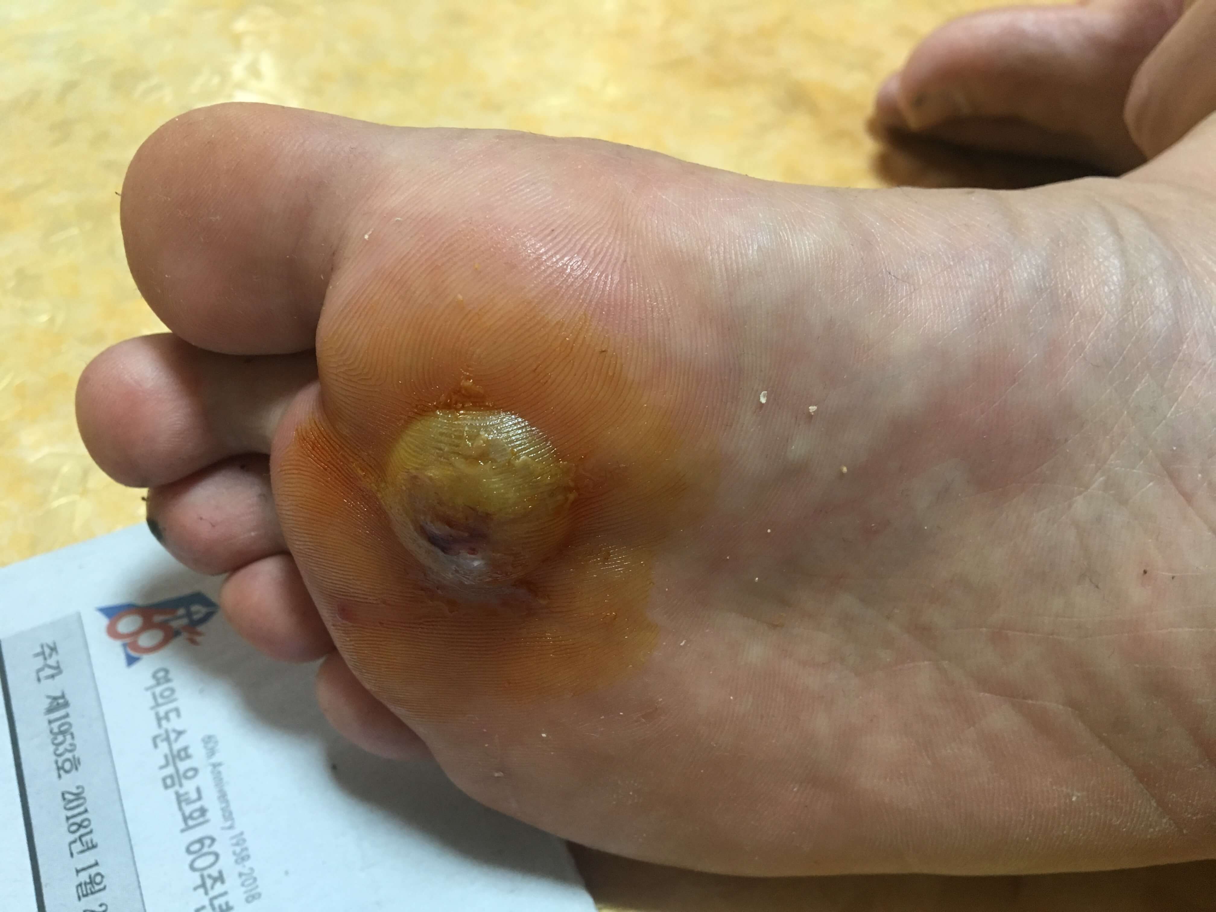 냉동치료 후 부풀어 오르며 물집이 생깁니다.