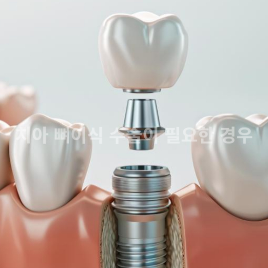 임플란트 나사 잇몸