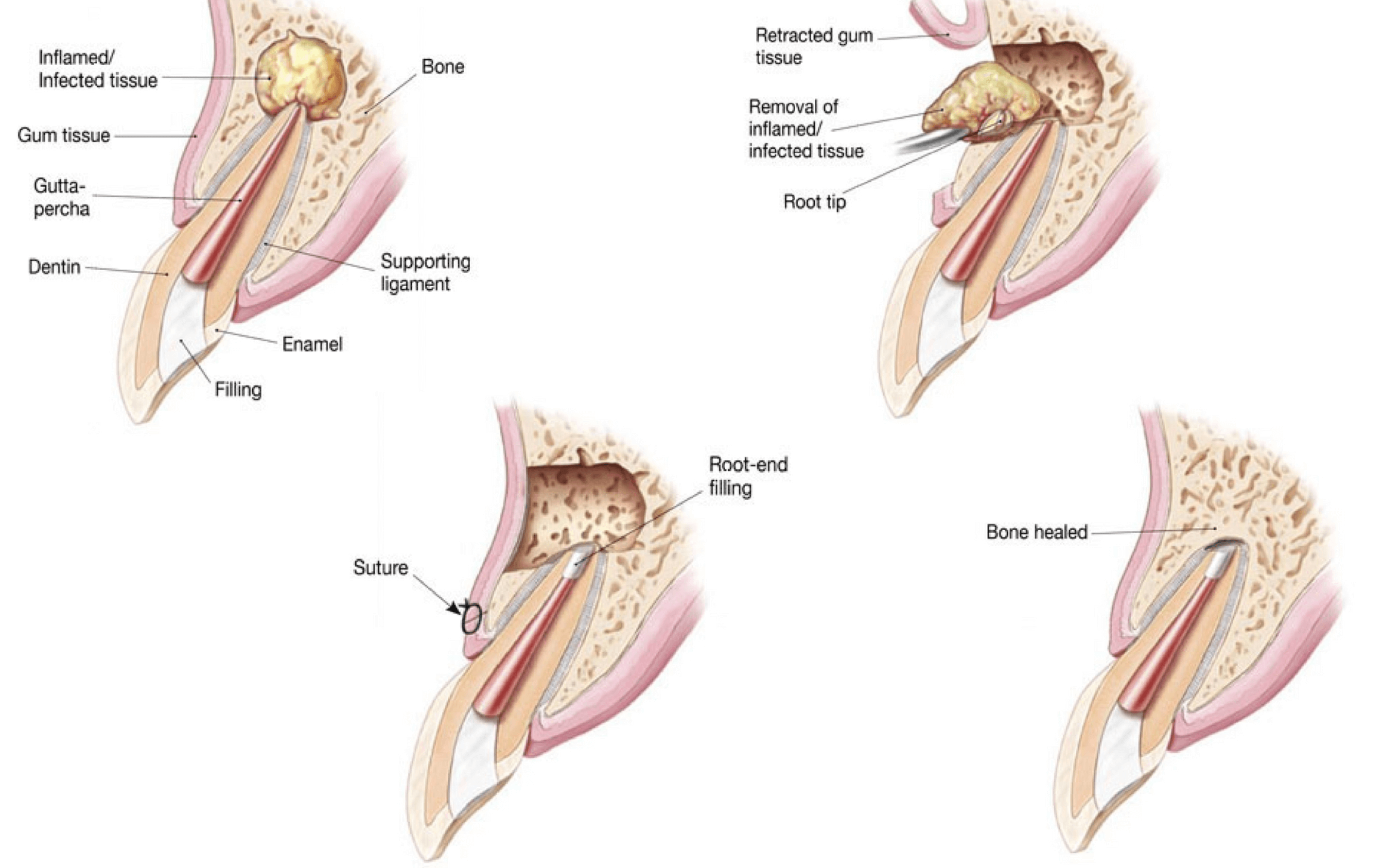 치근단절제술 방법