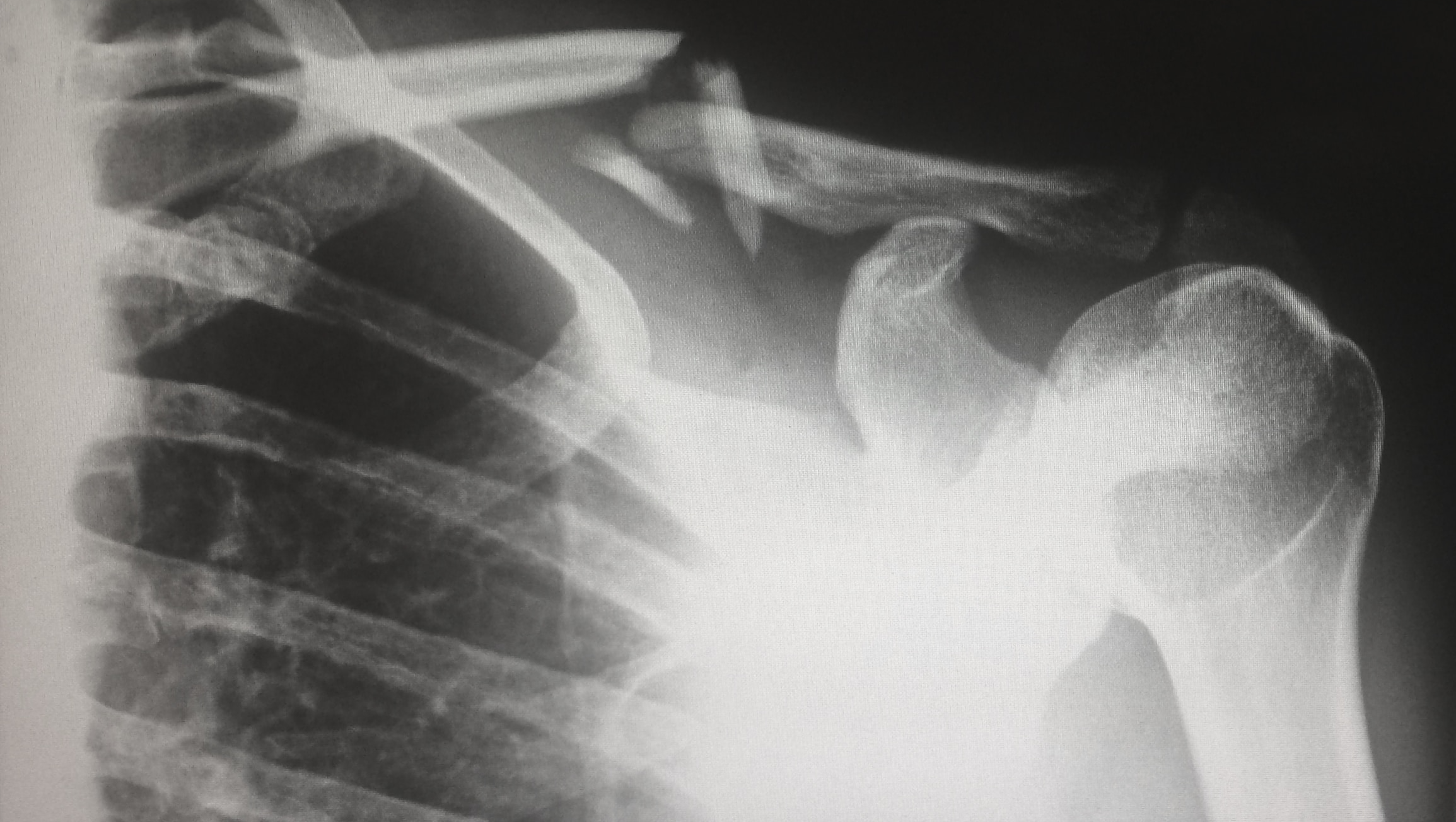 비타민D부족증상