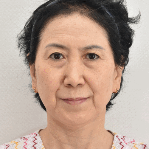 이마주름제거