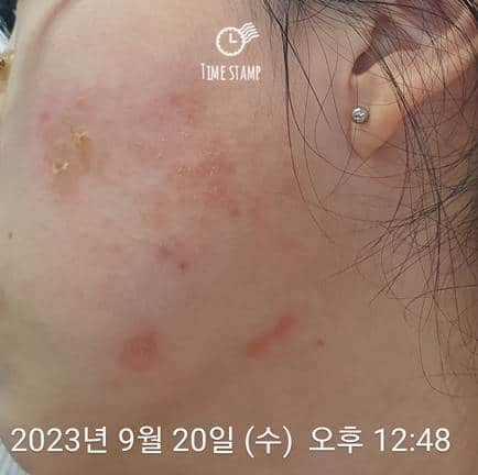 오른쪽 얼굴 피부염