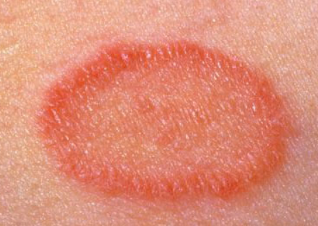 피부 붉은반점 1