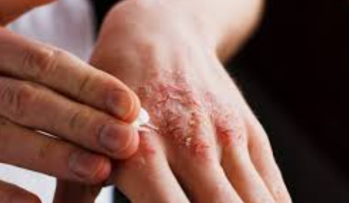 습진의 증상