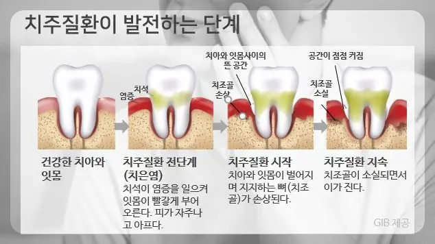 치주질환