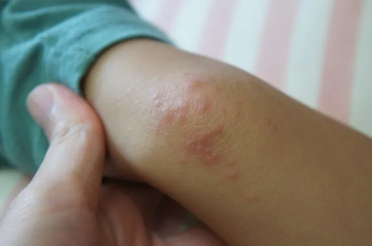 팔꿈치에-생긴-염증