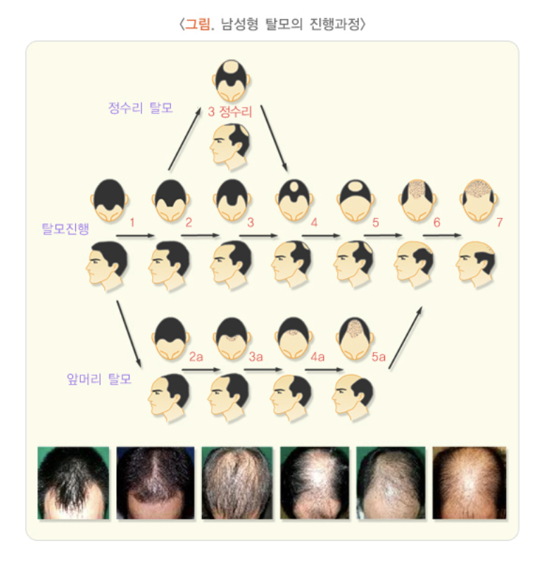 탈모 진행과정