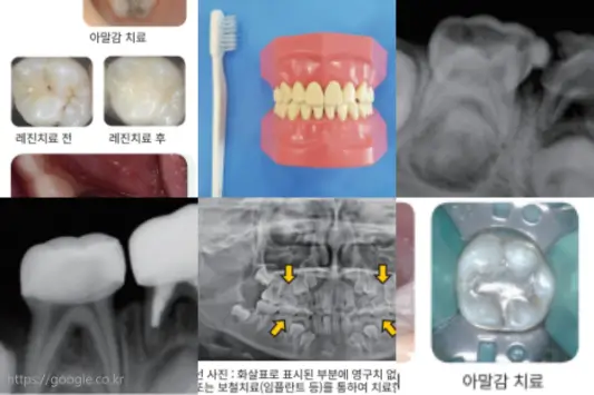 경기도-어린이-치과-충치-치료
