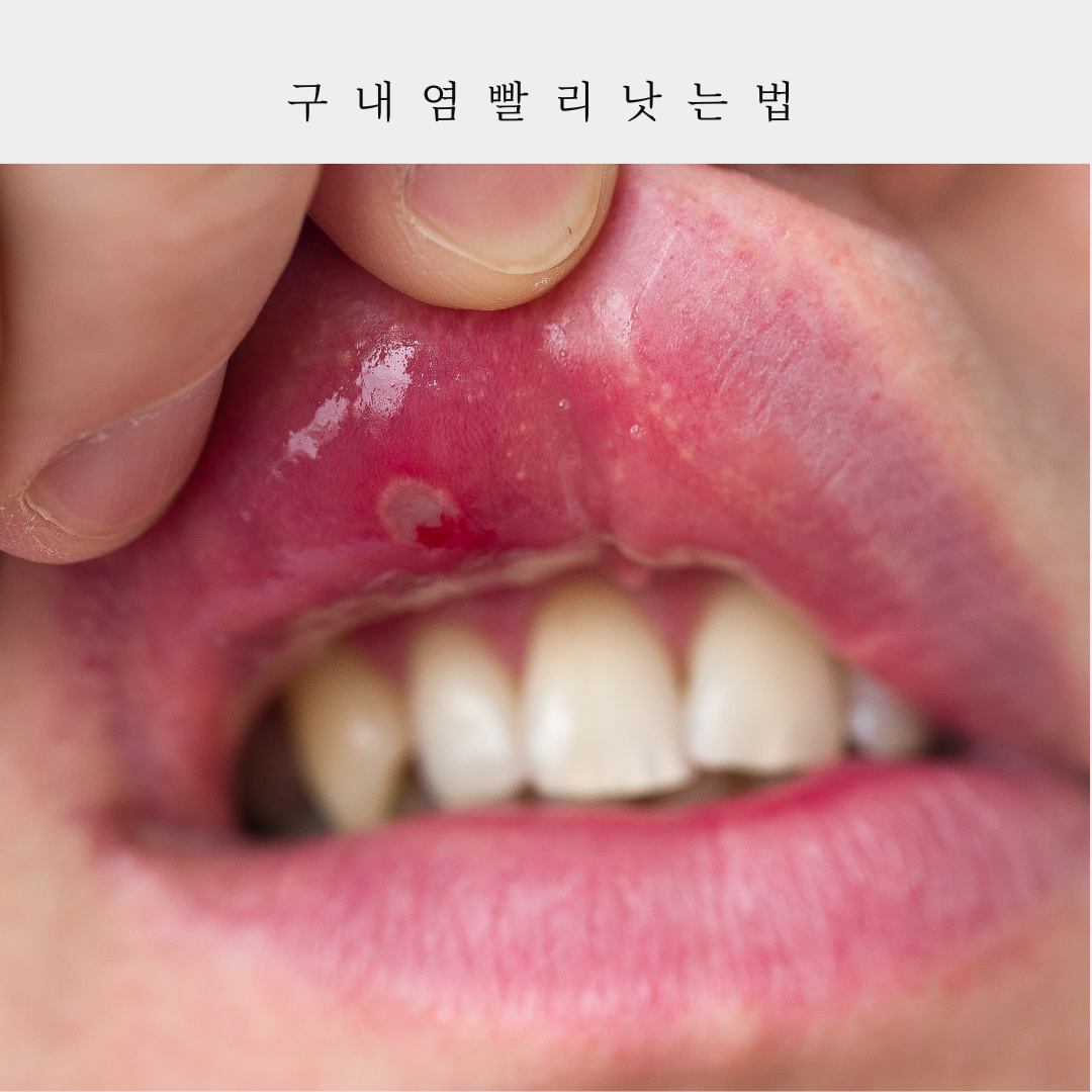 구내염-원인-증상-빨리-낫는-법