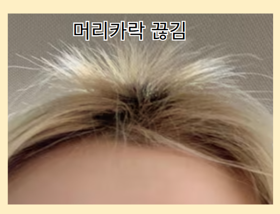 탈모 증상 - 머리카락 쉽게 끊김