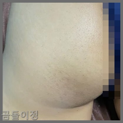 성인 엉덩이 두드러기 땀띠 뾰루지, 병원 안 가고 해결한 방법
