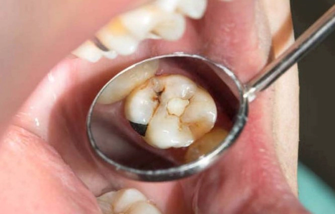 치아 우식단계별 증상 치료 