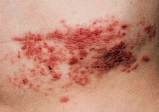 대상포진 물집이 딱지로 변한 상태