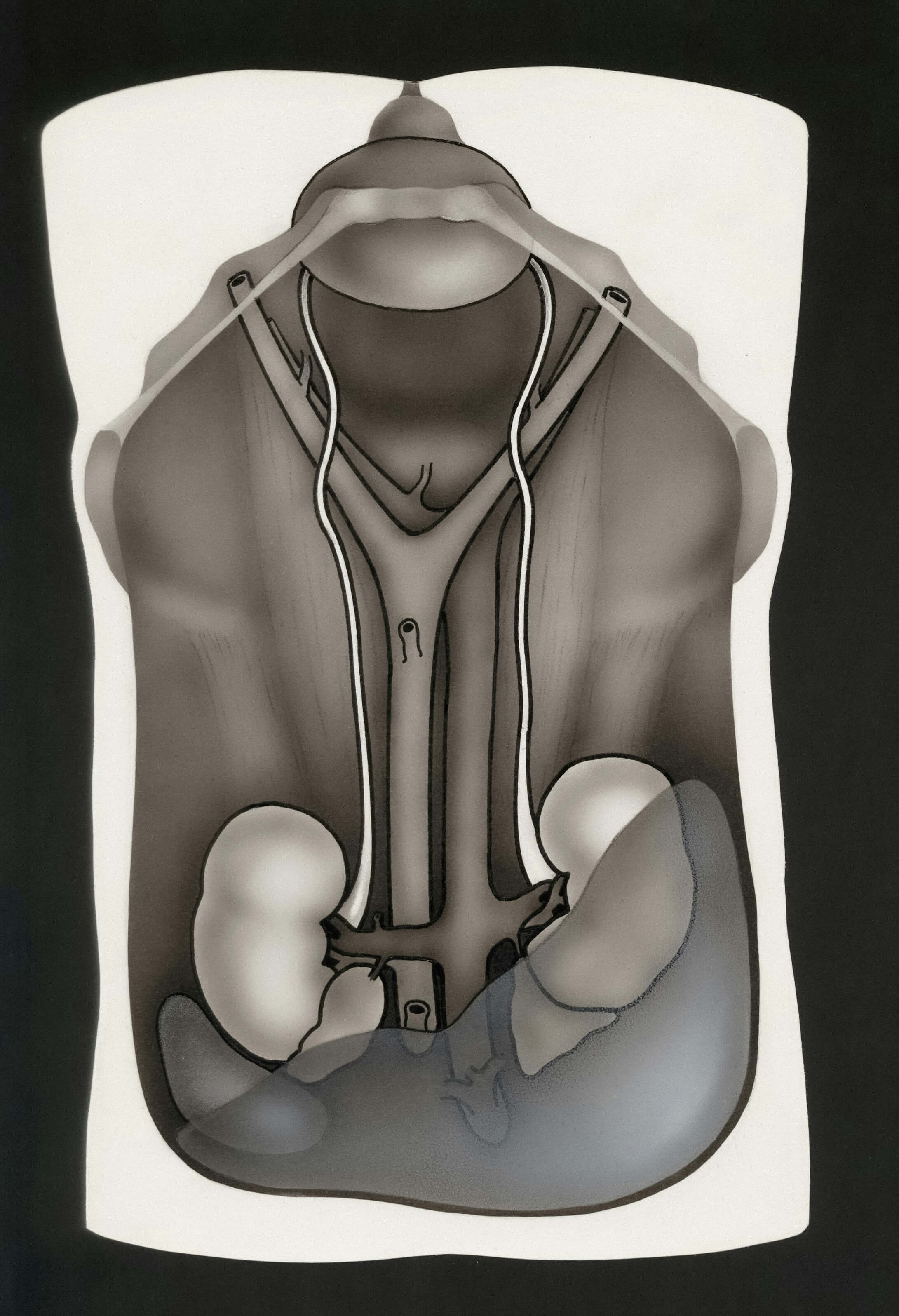 폐기흉(기흉)- 증상, -원인,-치료 -2