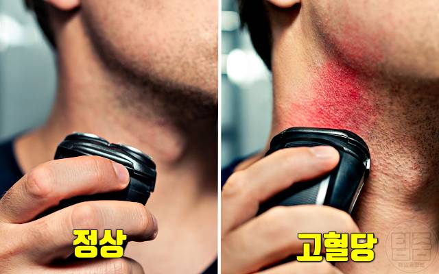 남자 당뇨 증상 특징 내분비내과 전문의 피셜