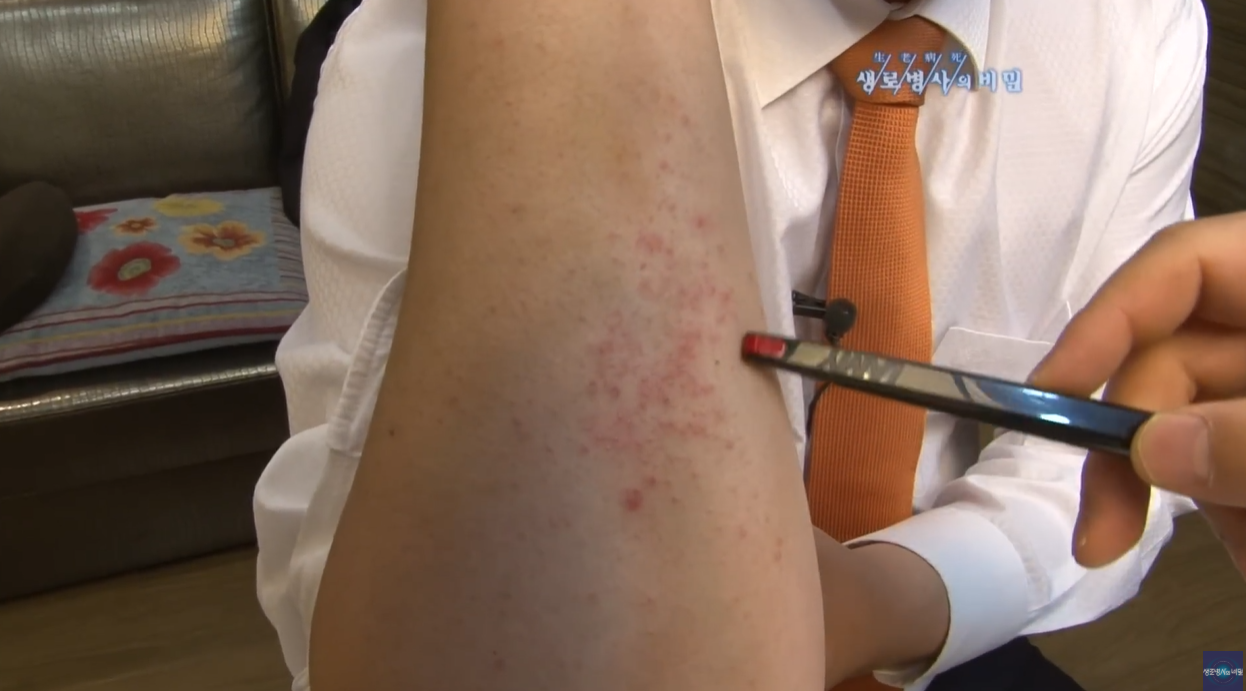 여름철피부건강 광알레르기 광민감성피부염 아토피 다한증 보상성다한증 액취증 콜린성두드러기 무좀