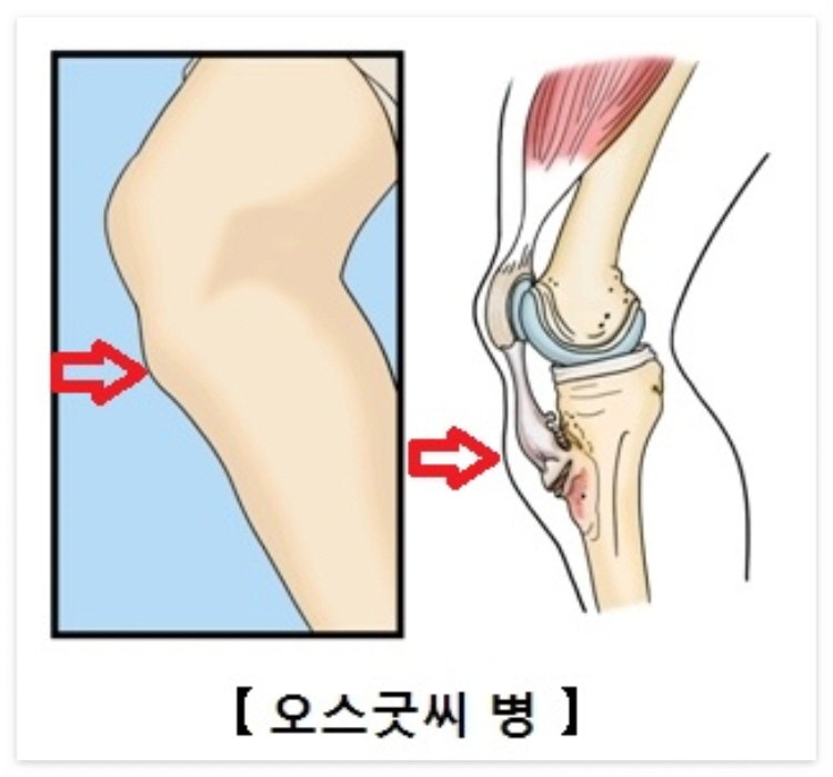 오스굿씨 병