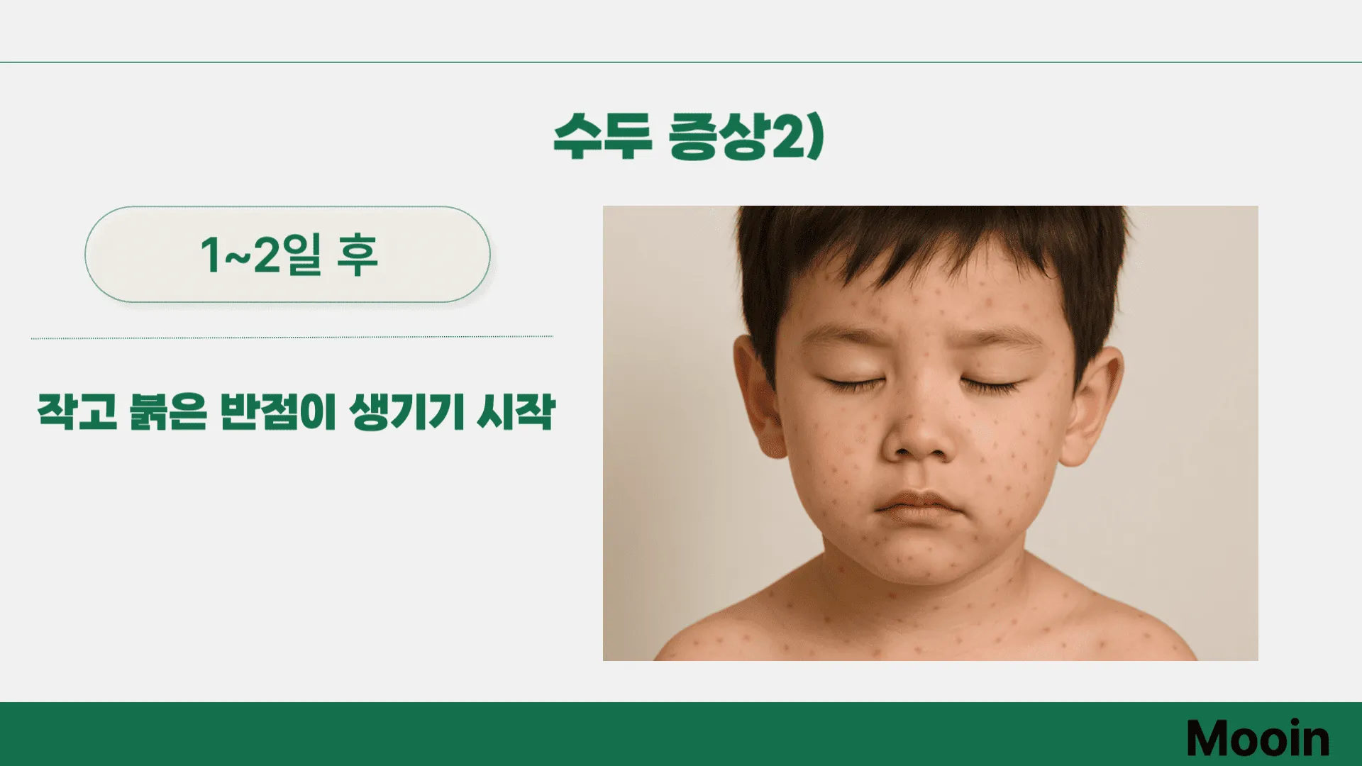 수두 증상2)