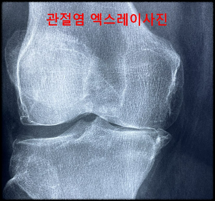 관절염-엑스레이사진