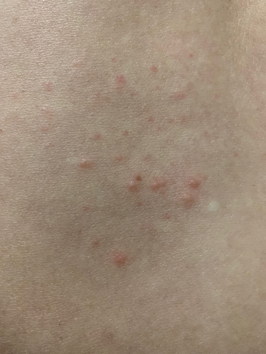 대상포진치료방법