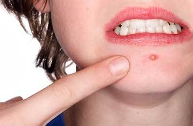 부위별 여드름 원인