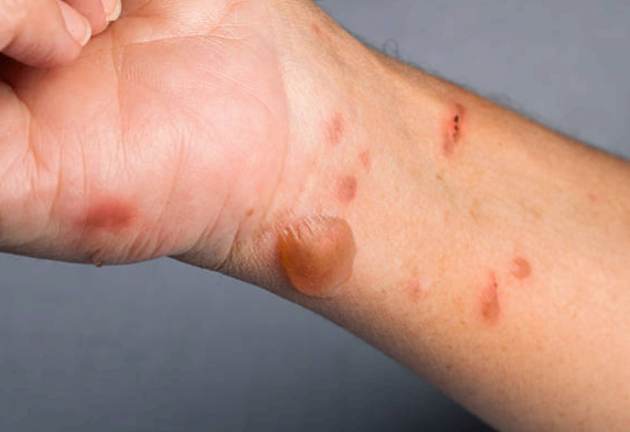 대상포진 증상 수포 사진