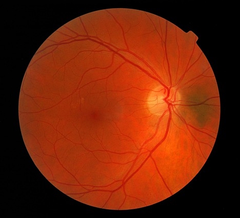 망막전막증 수술