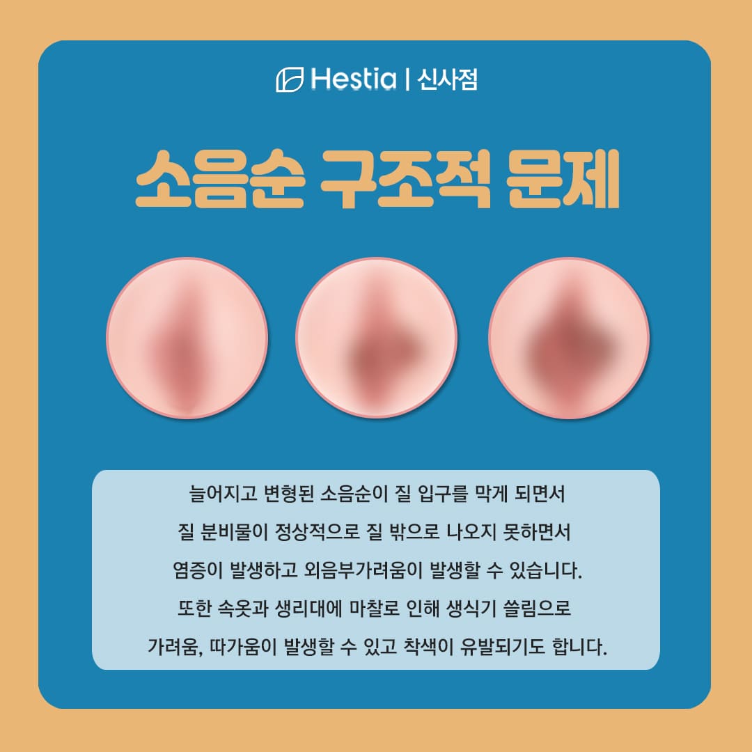소음순의 구조적 문제란?