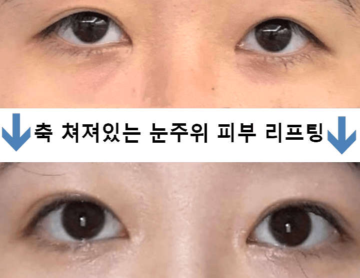 실리프팅-후기