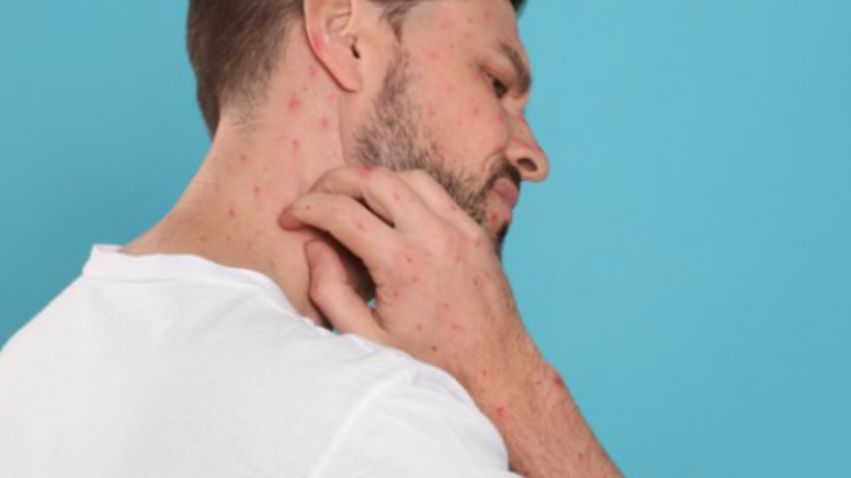 엠폭스-증상사진-감염경로