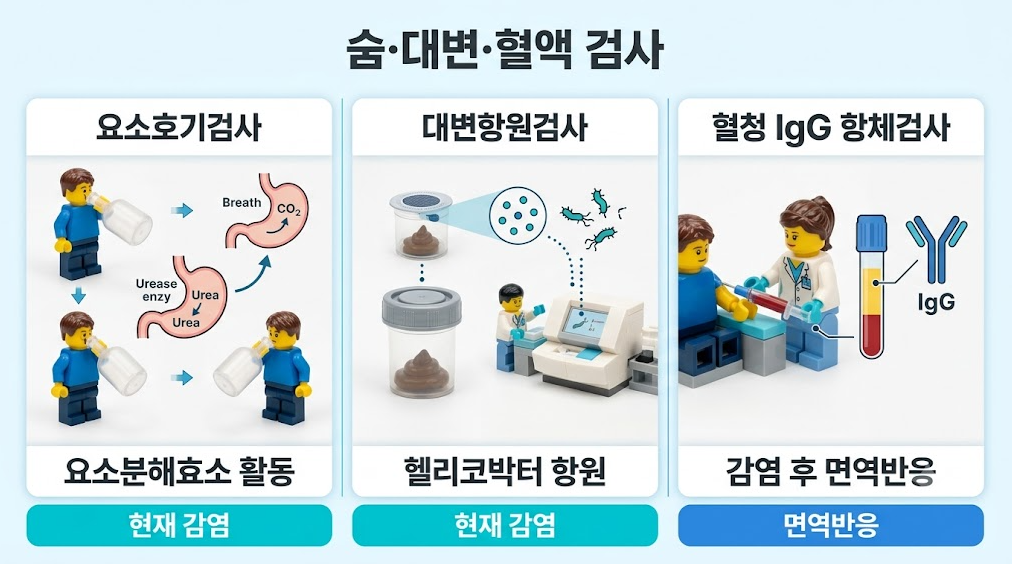 요소호기검사 대변항원검사 혈청 IgG 항체검사의 검체 및 특징 비교 인포그래픽