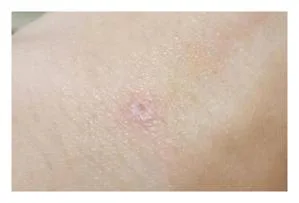 점생기는 이유
