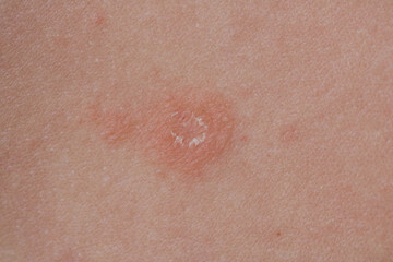 장미색 비강진 원인, 치료, 재발 등에 대해 알아봤습니다. 장미색 비강진은 pityriasis rosea이라고 불리는데요. 어떤 증상과 원인 치료가 있는지 꼼꼼히 읽어보세요!