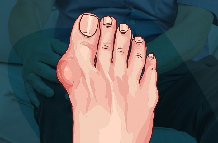 통풍 증상